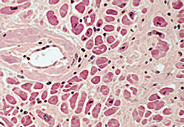 Tissue with amyloid infiltrates